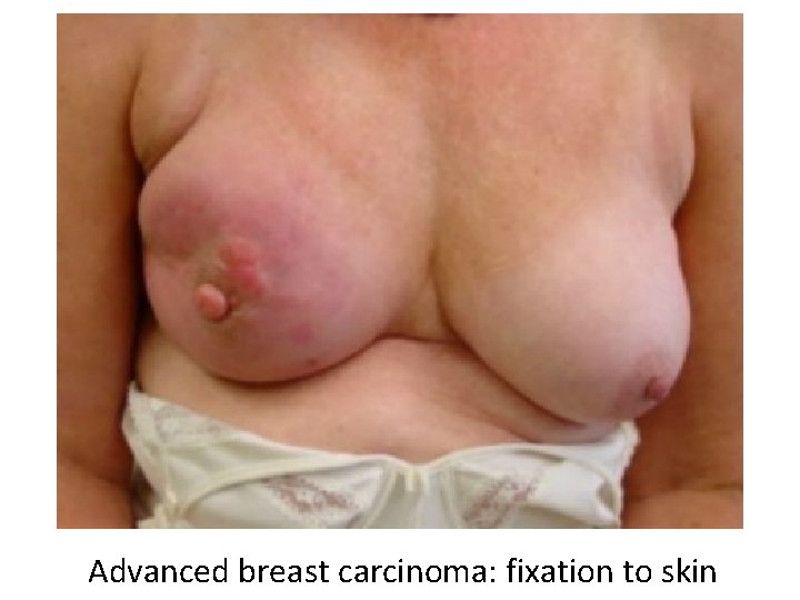 Advanced breast carcinoma: fixation to skin 