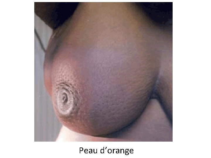 Peau d’orange 
