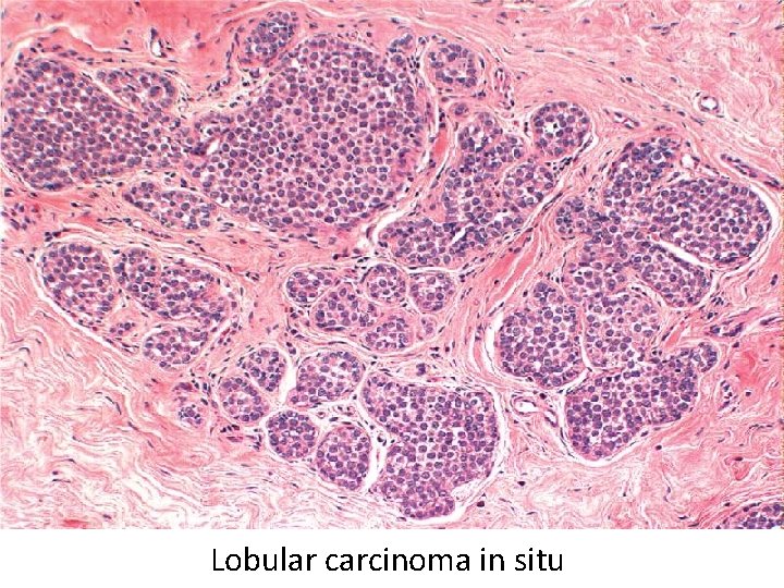 Lobular carcinoma in situ 