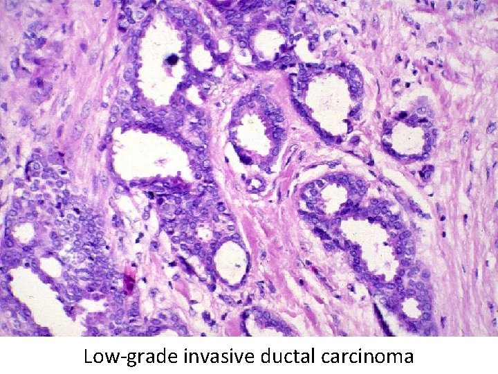 Low-grade invasive ductal carcinoma 