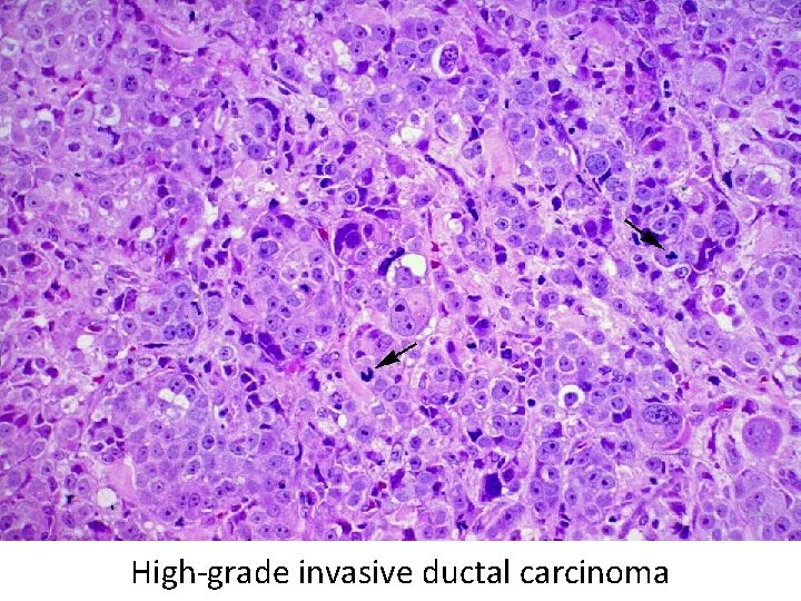 High-grade invasive ductal carcinoma 
