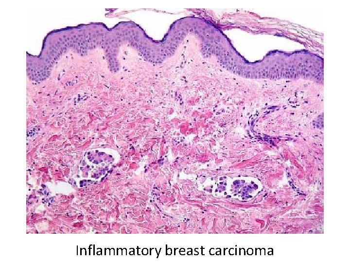 Inflammatory breast carcinoma 