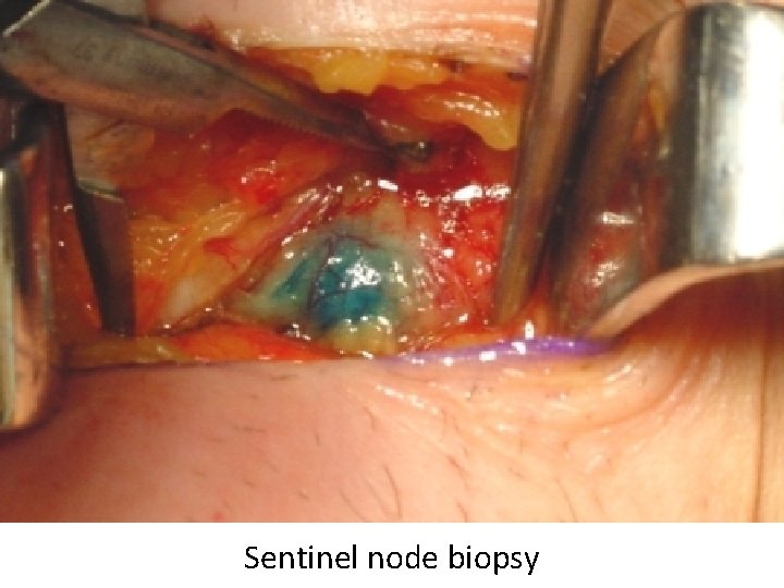Sentinel node biopsy 
