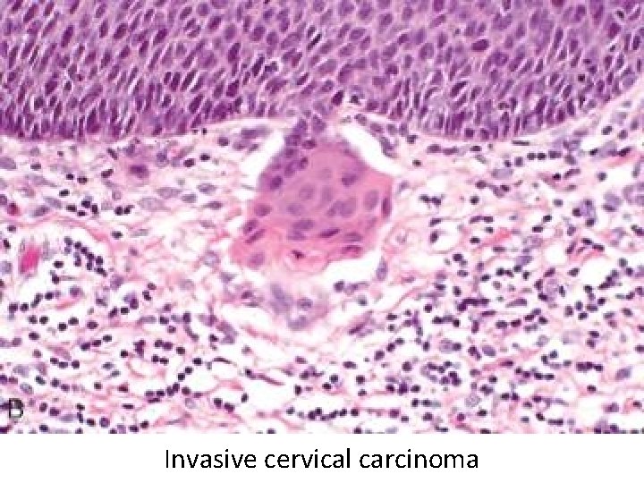Invasive cervical carcinoma 