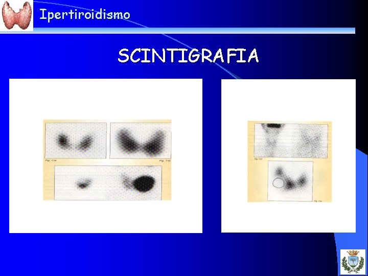 Ipertiroidismo SCINTIGRAFIA 