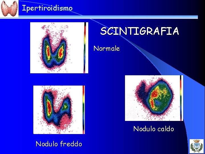 Ipertiroidismo SCINTIGRAFIA Normale Nodulo caldo Nodulo freddo 