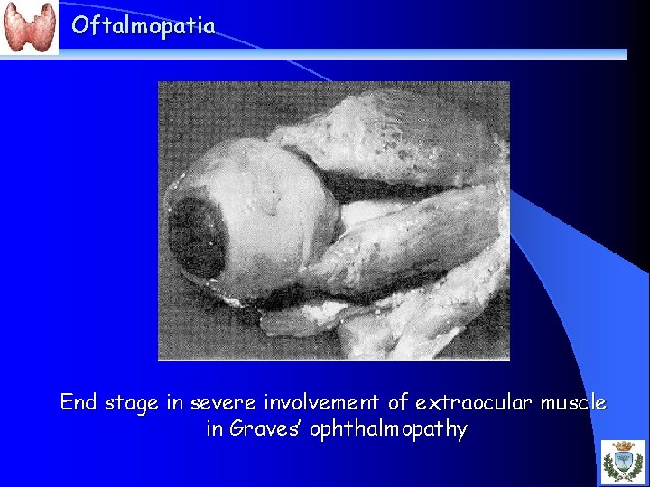 Oftalmopatia End stage in severe involvement of extraocular muscle in Graves’ ophthalmopathy 