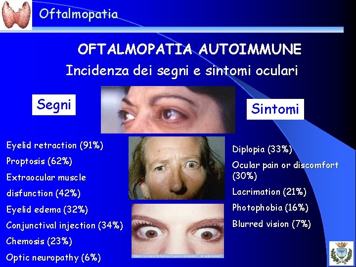 Oftalmopatia OFTALMOPATIA AUTOIMMUNE Incidenza dei segni e sintomi oculari Segni Eyelid retraction (91%) Proptosis