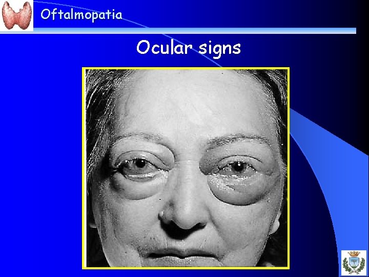 Oftalmopatia Ocular signs 
