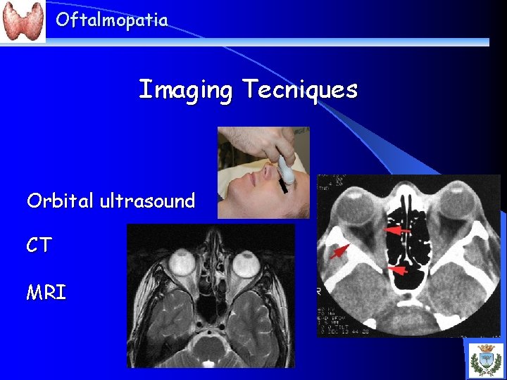 Oftalmopatia Imaging Tecniques Orbital ultrasound CT MRI 