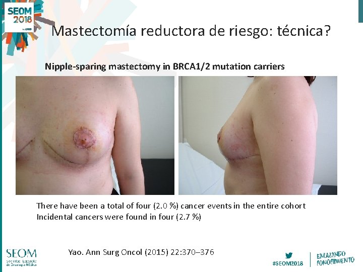 Mastectomía reductora de riesgo: técnica? Nipple-sparing mastectomy in BRCA 1/2 mutation carriers There have