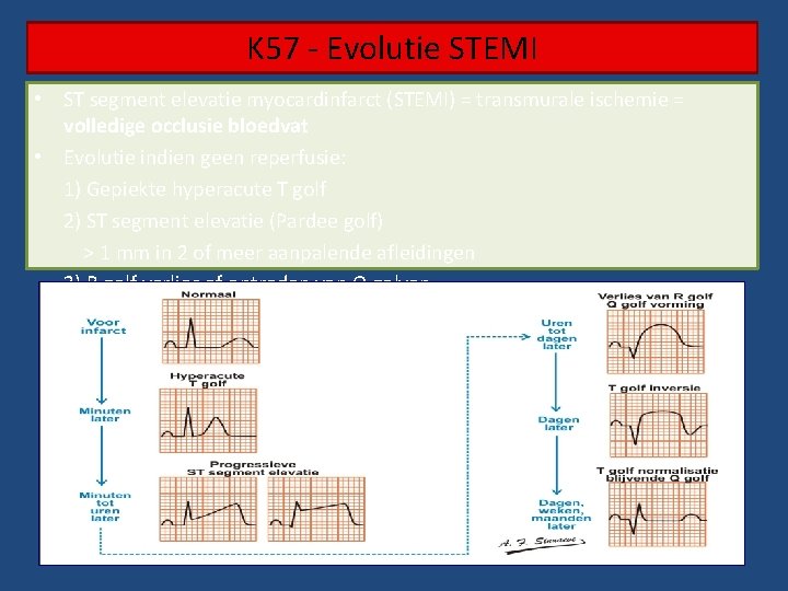 K 57 - Evolutie STEMI • ST segment elevatie myocardinfarct (STEMI) = transmurale ischemie