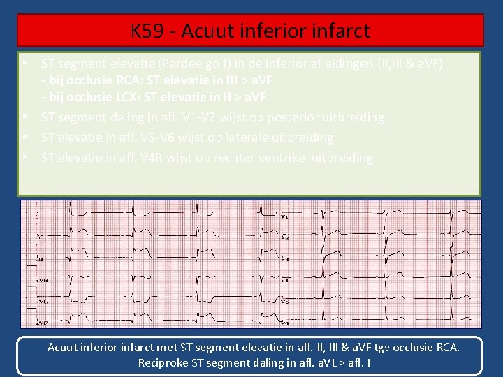K 59 - Acuut inferior infarct • ST segment elevatie (Pardee golf) in de