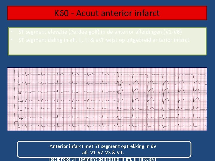 K 60 - Acuut anterior infarct • ST segment elevatie (Pardee golf) in de
