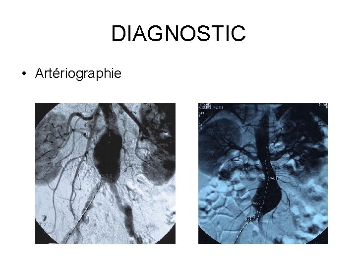 DIAGNOSTIC • Artériographie 