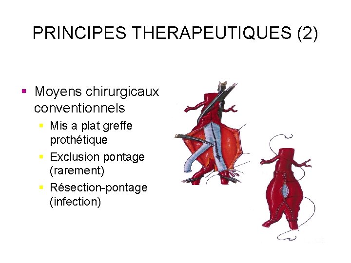 PRINCIPES THERAPEUTIQUES (2) § Moyens chirurgicaux conventionnels § Mis a plat greffe prothétique §