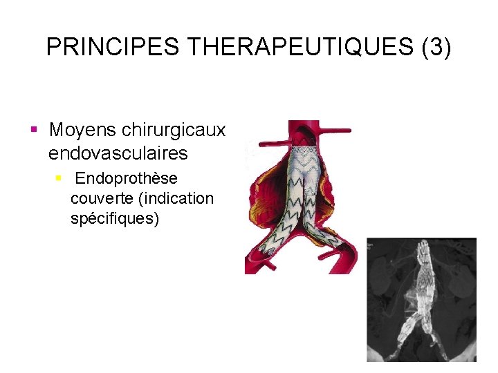 PRINCIPES THERAPEUTIQUES (3) § Moyens chirurgicaux endovasculaires § Endoprothèse couverte (indication spécifiques) 