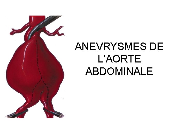 ANEVRYSMES DE L’AORTE ABDOMINALE 