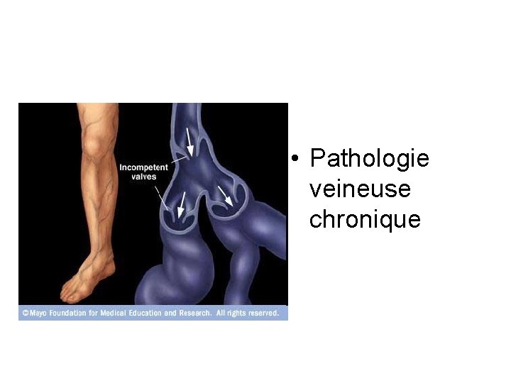  • Pathologie veineuse chronique 