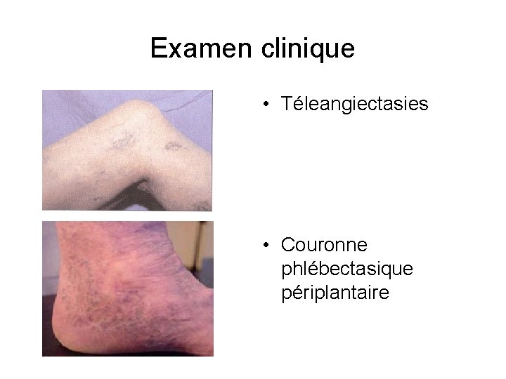 Examen clinique • Téleangiectasies • Couronne phlébectasique périplantaire 