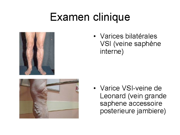 Examen clinique • Varices bilatérales VSI (veine saphène interne) • Varice VSI-veine de Leonard