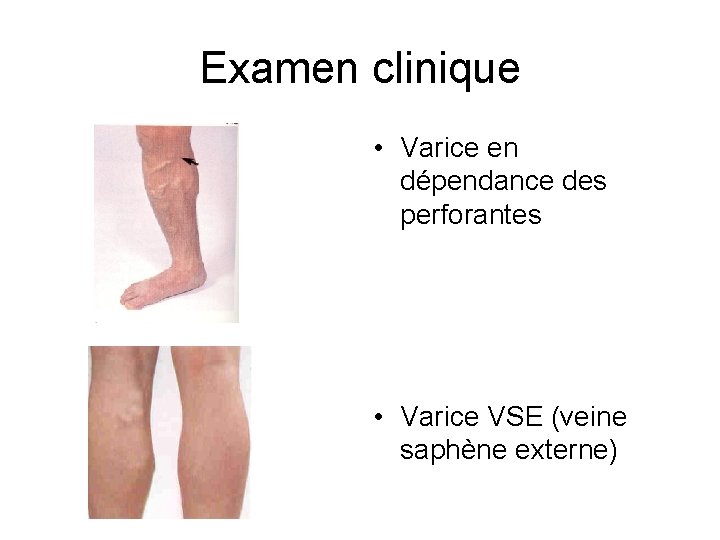 Examen clinique • Varice en dépendance des perforantes • Varice VSE (veine saphène externe)