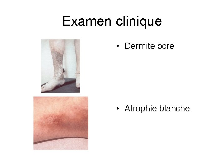 Examen clinique • Dermite ocre • Atrophie blanche 