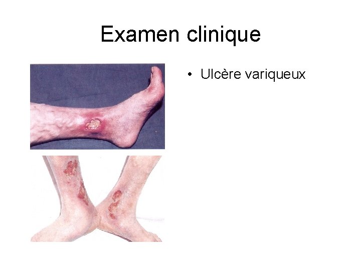 Examen clinique • Ulcère variqueux 