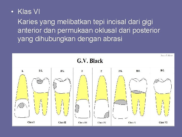  • Klas VI Karies yang melibatkan tepi incisal dari gigi anterior dan permukaan