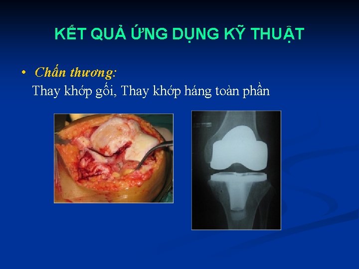 KẾT QUẢ ỨNG DỤNG KỸ THUẬT • Chấn thương: Thay khớp gối, Thay khớp