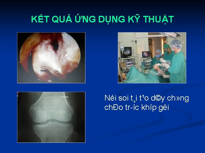 KẾT QUẢ ỨNG DỤNG KỸ THUẬT Néi soi t¸i t¹o d©y ch» ng chÐo