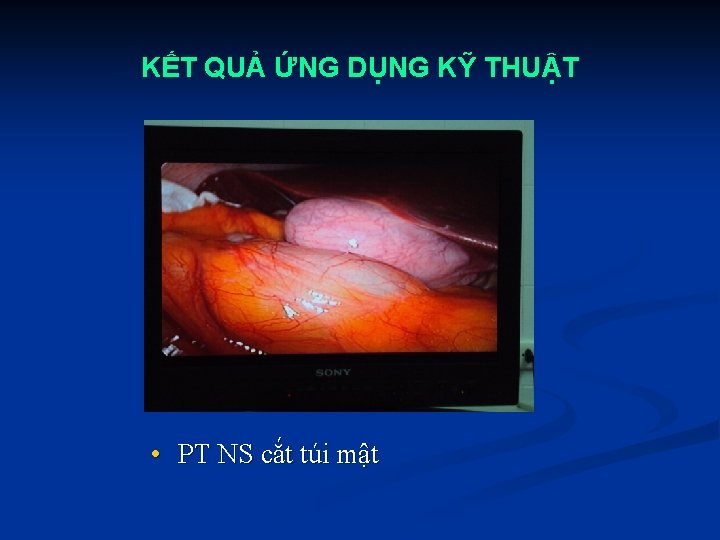 KẾT QUẢ ỨNG DỤNG KỸ THUẬT • PT NS cắt túi mật 