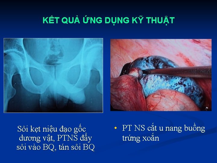 KẾT QUẢ ỨNG DỤNG KỸ THUẬT Sỏi kẹt niệu đạo gốc dương vật, PTNS