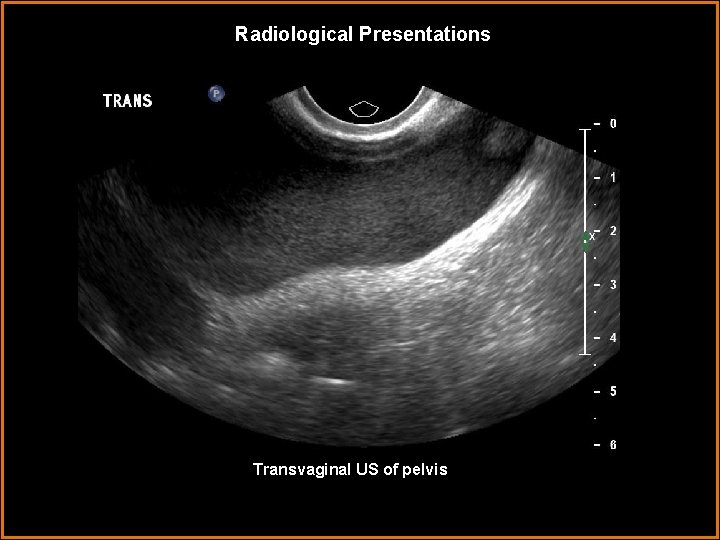 Radiological Presentations Transvaginal US of pelvis 