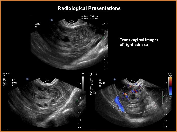 Radiological Presentations Transvaginal images of right adnexa 