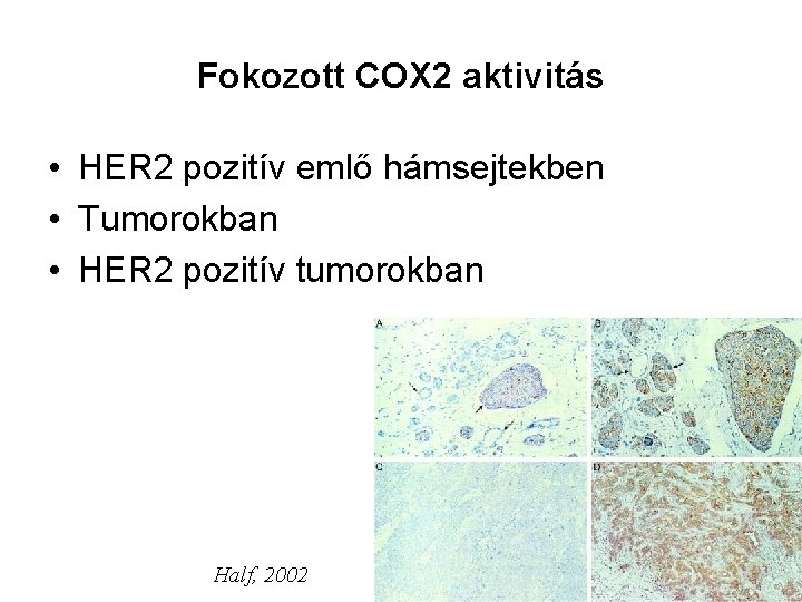 Fokozott COX 2 aktivitás • HER 2 pozitív emlő hámsejtekben • Tumorokban • HER