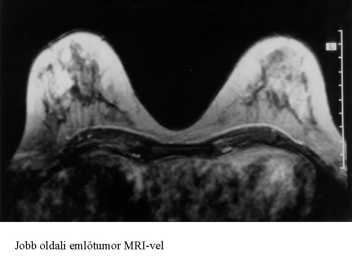 Jobb oldali emlőtumor MRI-vel 