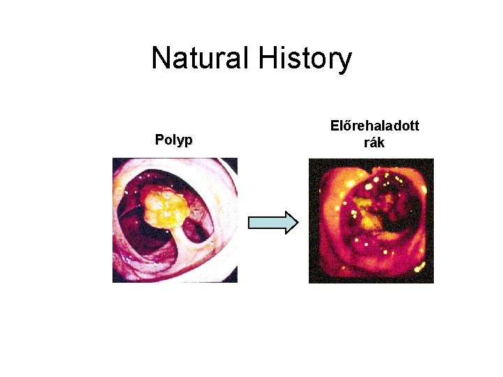 Natural History Polyp Előrehaladott rák 