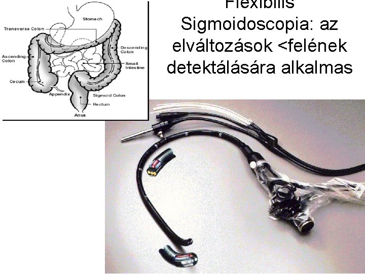 Flexibilis Sigmoidoscopia: az elváltozások <felének detektálására alkalmas 
