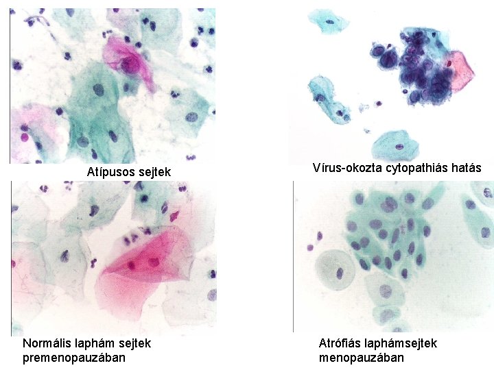 Atípusos sejtek Normális laphám sejtek premenopauzában Vírus-okozta cytopathiás hatás Atrófiás laphámsejtek menopauzában 