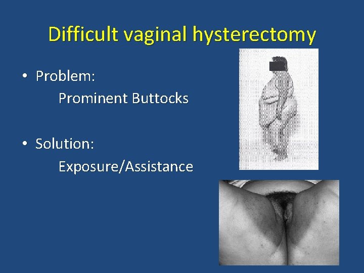 Difficult vaginal hysterectomy • Problem: Prominent Buttocks • Solution: Exposure/Assistance 