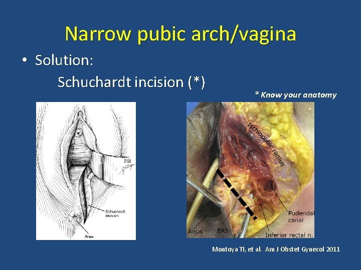 Narrow pubic arch/vagina • Solution: Schuchardt incision (*) * Know your anatomy Montoya TI,