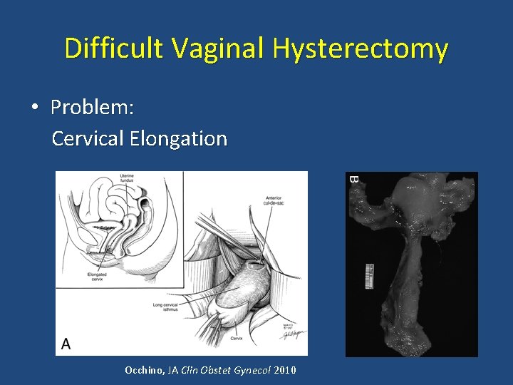 Difficult Vaginal Hysterectomy • Problem: Cervical Elongation Occhino, JA Clin Obstet Gynecol 2010 