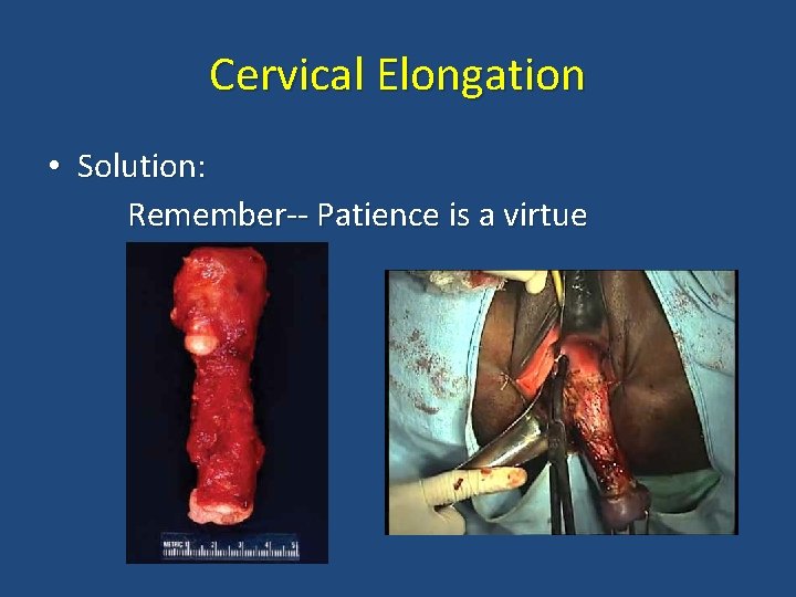 Cervical Elongation • Solution: Remember-- Patience is a virtue 
