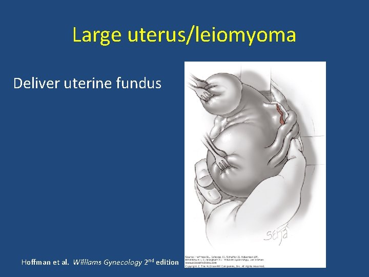 Large uterus/leiomyoma Deliver uterine fundus Hoffman et al. Williams Gynecology 2 nd edition 