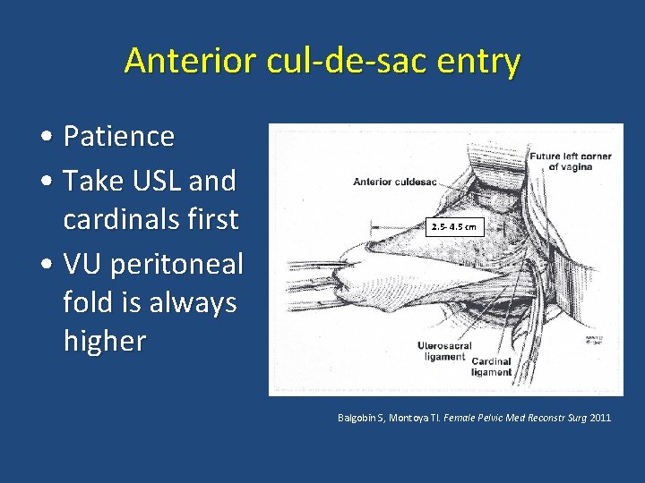 Anterior cul-de-sac entry • Patience • Take USL and cardinals first • VU peritoneal