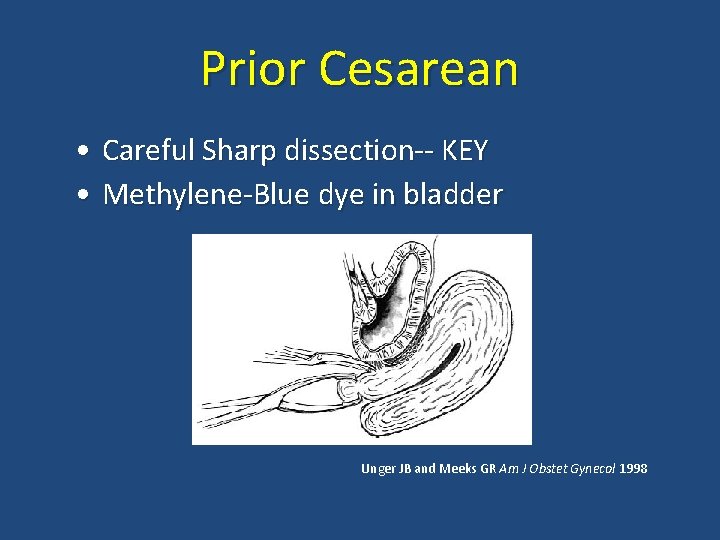 Prior Cesarean • Careful Sharp dissection-- KEY • Methylene-Blue dye in bladder Unger JB