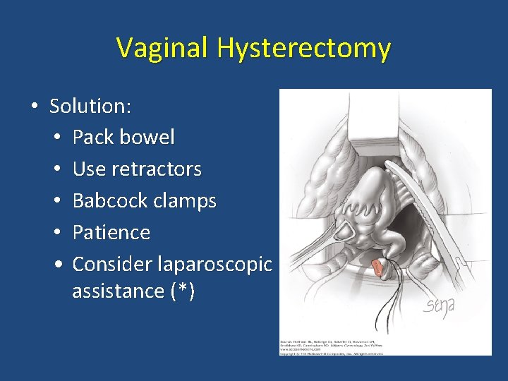 Vaginal Hysterectomy • Solution: • Pack bowel • Use retractors • Babcock clamps •