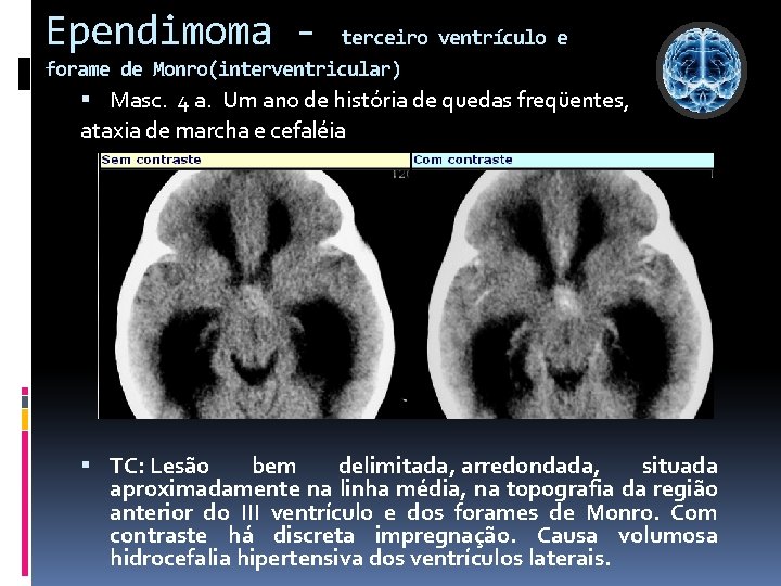 Ependimoma - terceiro ventrículo e forame de Monro(interventricular) Masc. 4 a. Um ano de