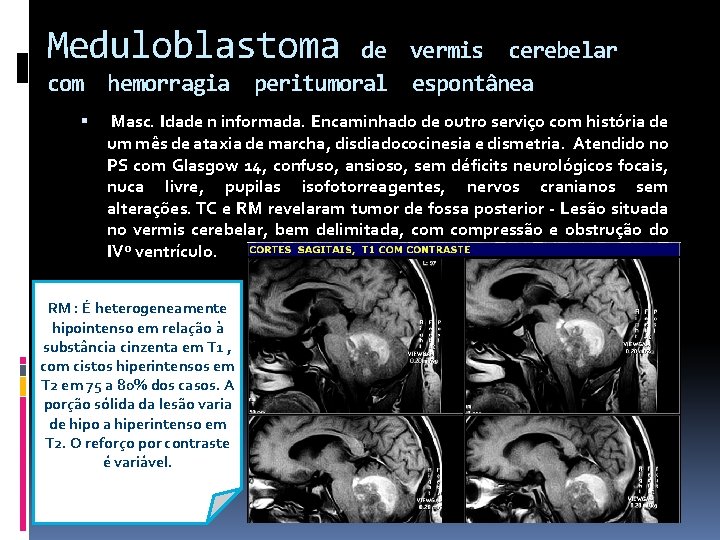 Meduloblastoma de vermis cerebelar com hemorragia peritumoral espontânea Masc. Idade n informada. Encaminhado de